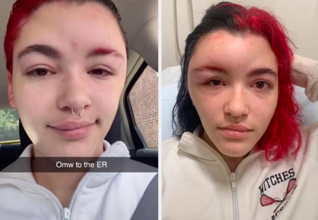 Joven revela que se le hinchó la cabeza por teñirse el cabello - Vimarsana News