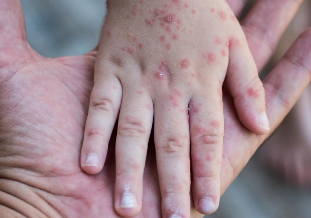¿Qué es el virus de 'boca, mano y pie'? Afecta a niños pequeños